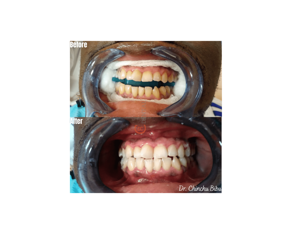 Teeth Whitening - CDental Clinics, Sharjah