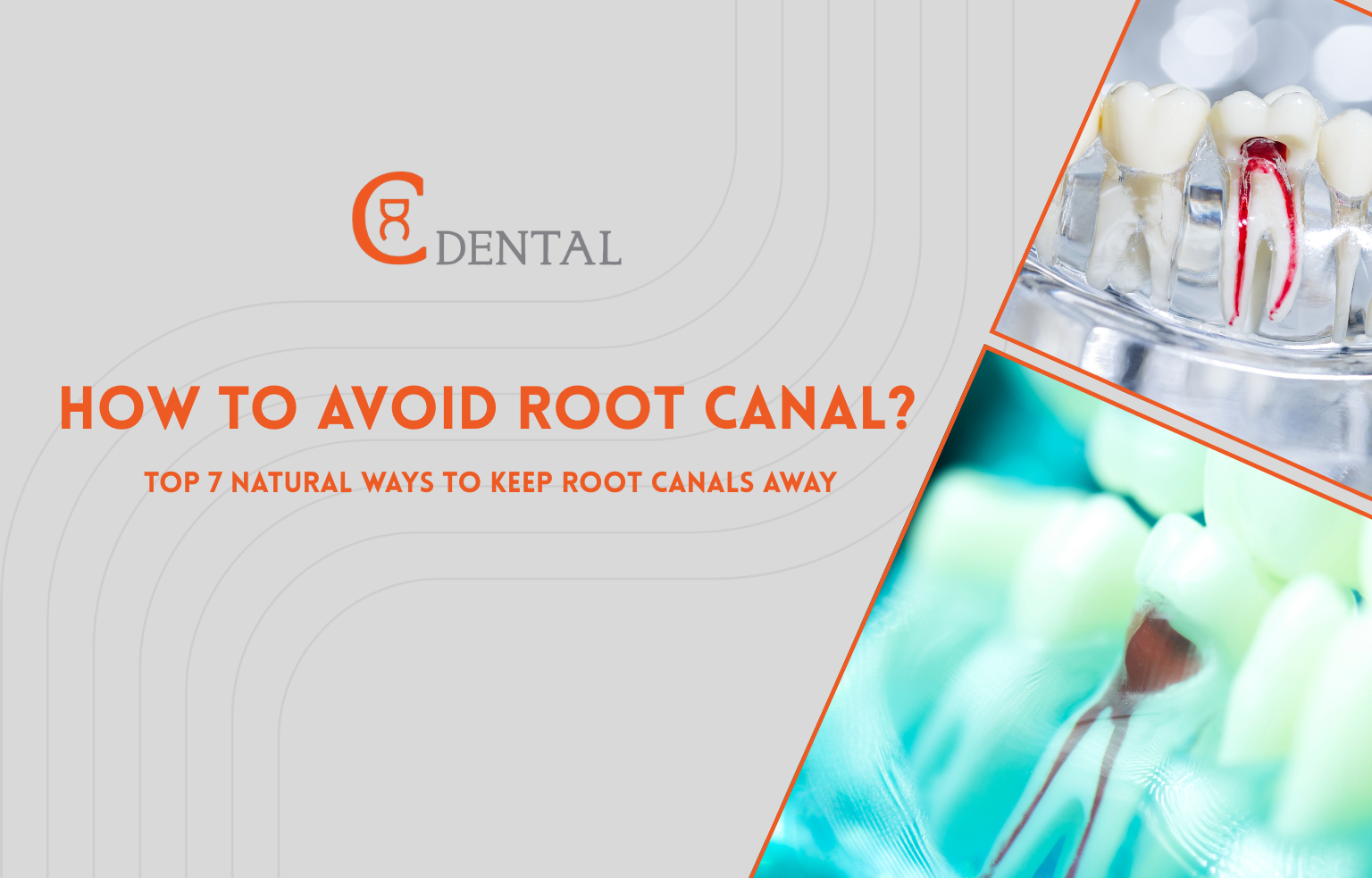 How To Avoid Root Canal​? Top 7 Natural Ways to Keep Root Canals Away
