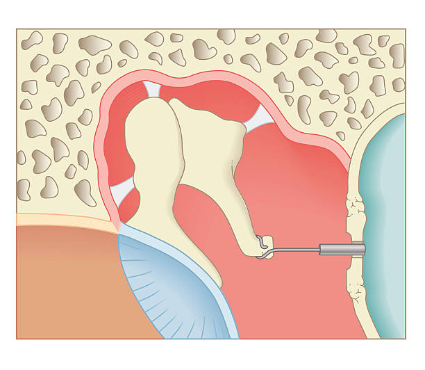 Apicectomy