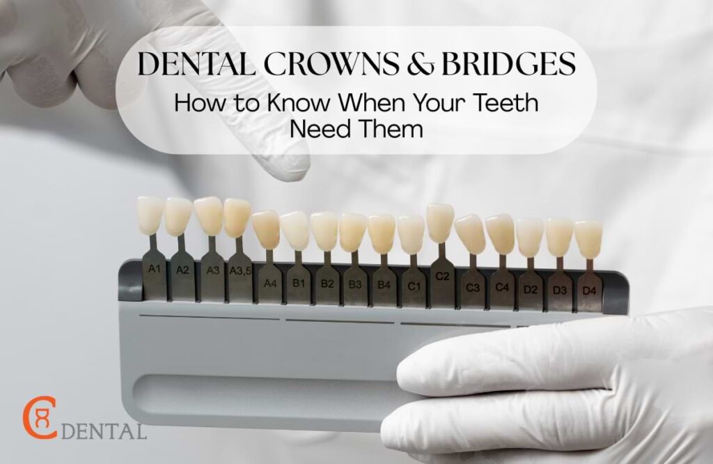 Dental Crowns