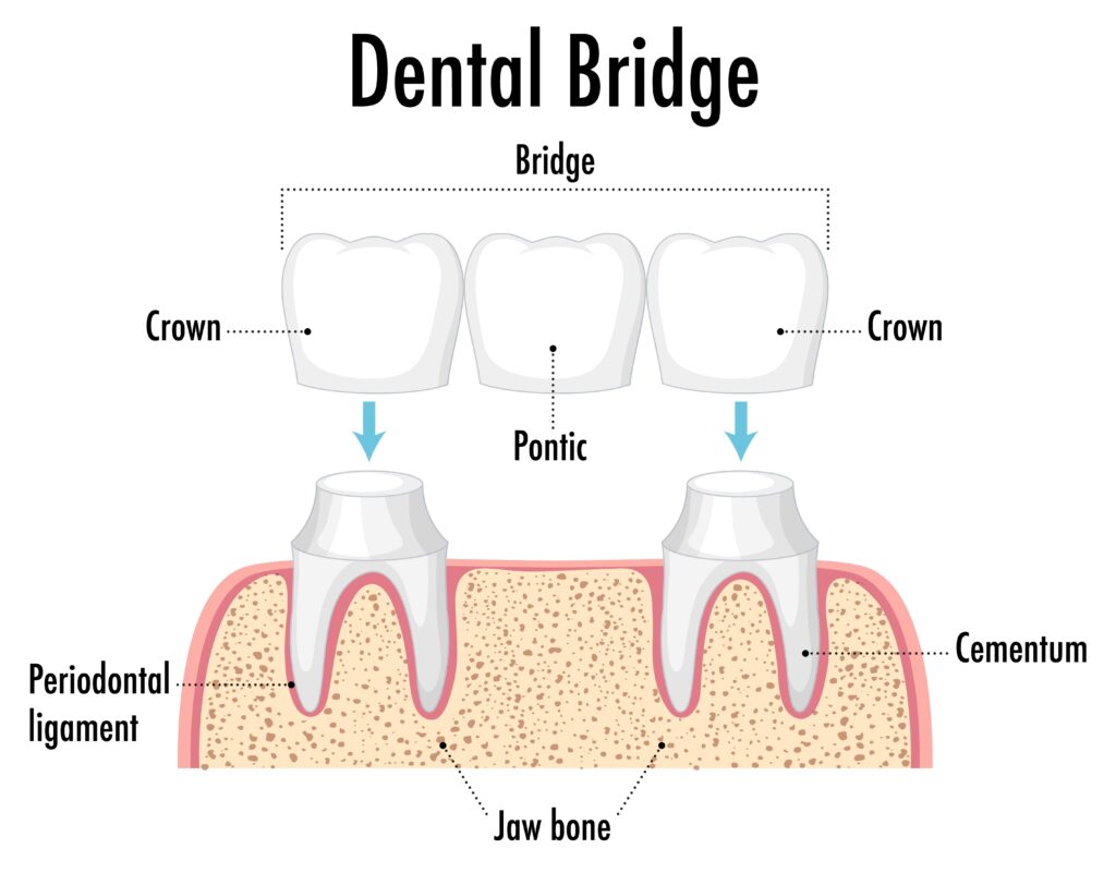 Dental bridge used to replace one missing tooth for better chewing