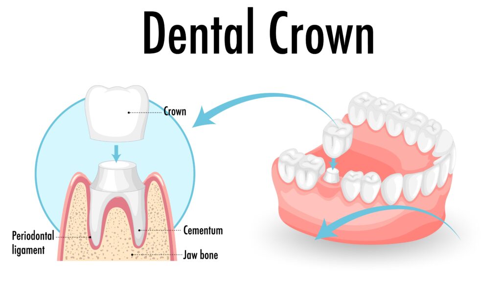 Dental crown covering a damaged tooth surface.