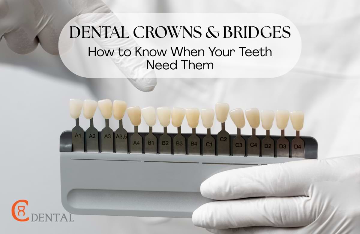 Dental Crowns & Bridges: How to Know When Your Teeth Need Them
