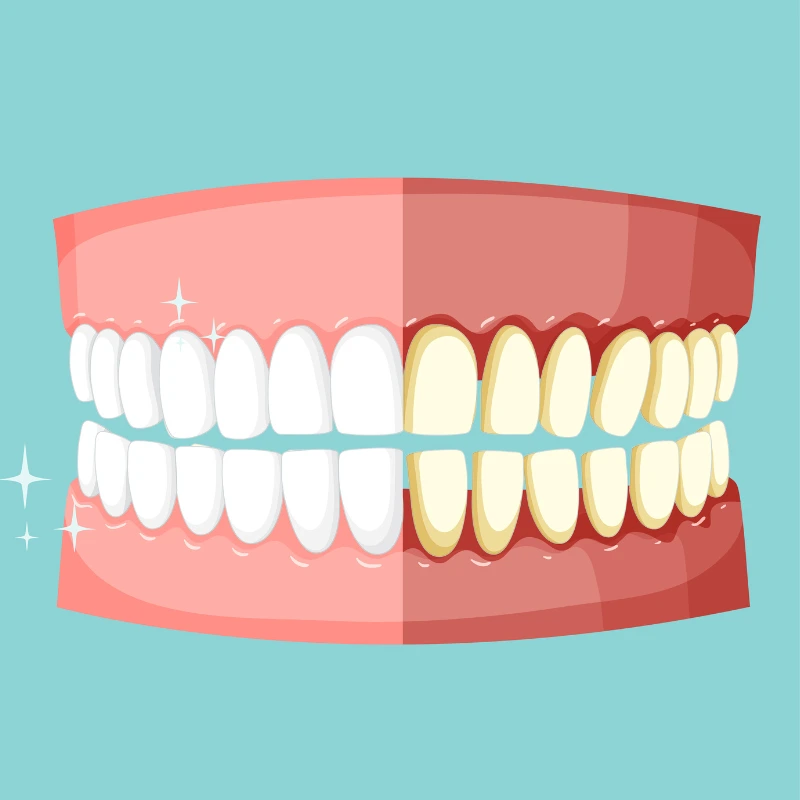 Tooth discoloration caused by smoking with yellow and brown stains on enamel