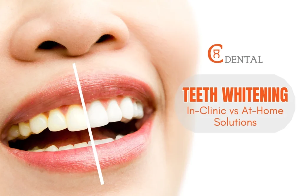 Teeth whitening methods: professional clinic treatment vs home whitening kits
