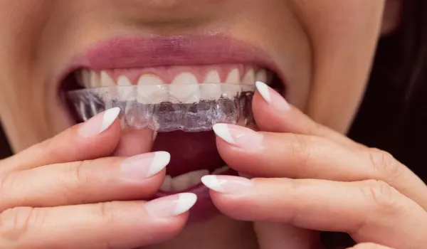 Clear aligners used in cosmetic dentistry to gently correct misaligned teeth without braces