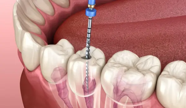 What Is a Root Canal Treatment?