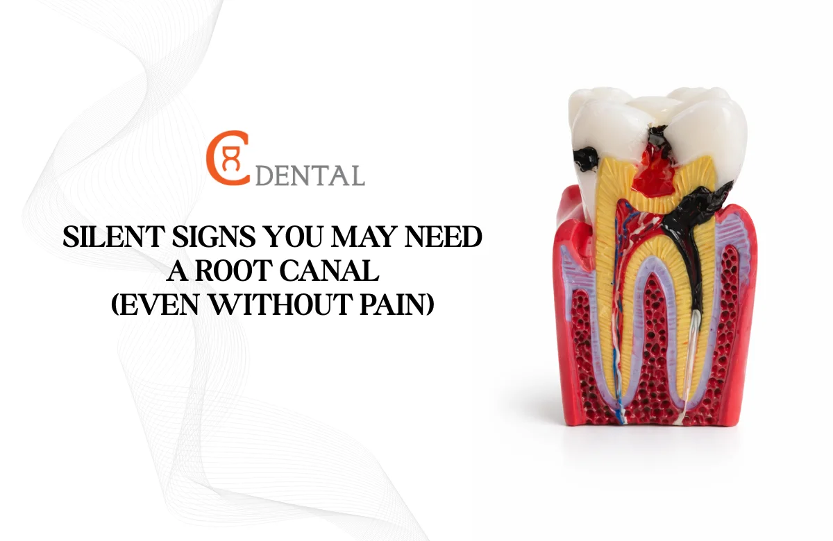Silent Signs You May Need a Root Canal (Even Without Pain)