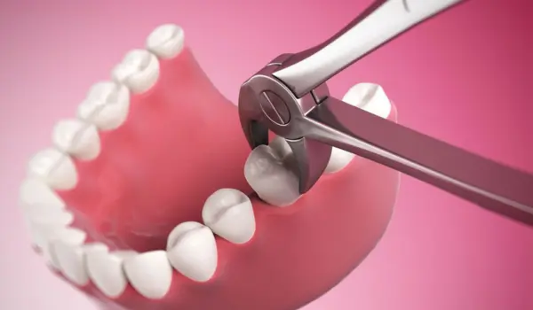 What Is Tooth Extraction?