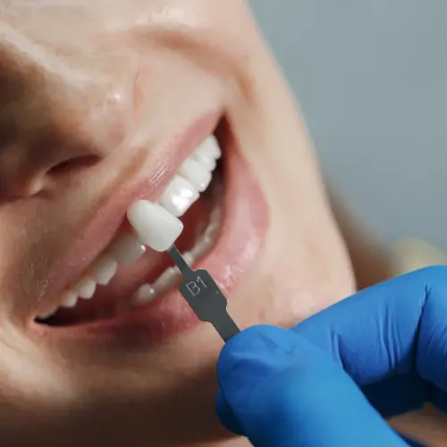 Close-up of teeth with porcelain veneers for a natural, bright, confident smile