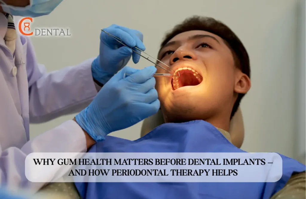 Why Gum Health Matters Before Dental Implants