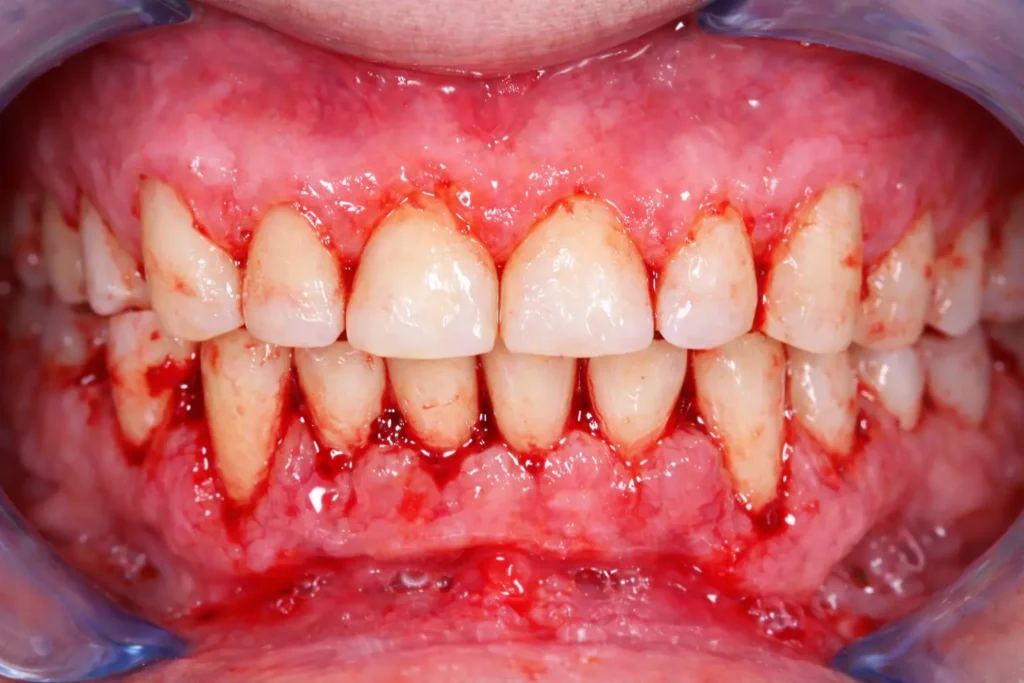 What Is Gingivitis?