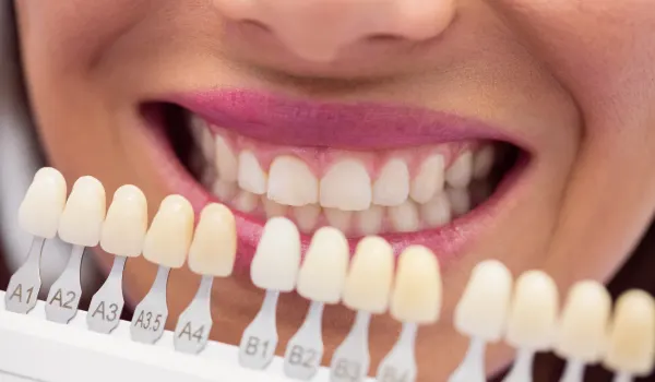 Porcelain veneers providing instant cosmetic alignment for a straighter, brighter smile