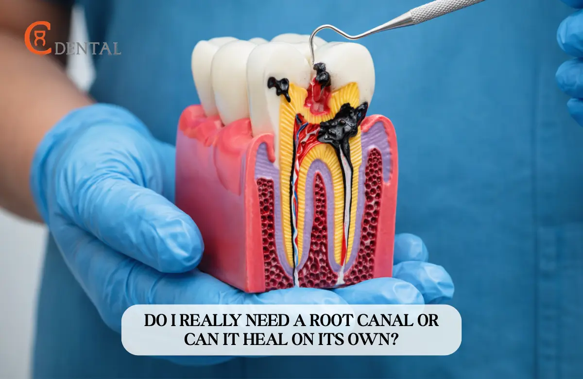 Do I Really Need a Root Canal or Can It Heal on Its Own?