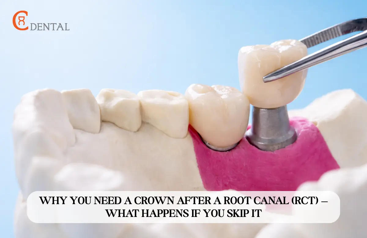 Why You Need a Crown After a Root Canal (RCT) &mdash; What Happens If You Skip It?