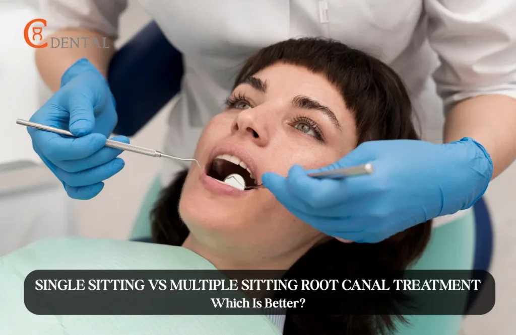 Single Sitting vs Multiple Sitting Root Canal Treatment: Which Is Better?