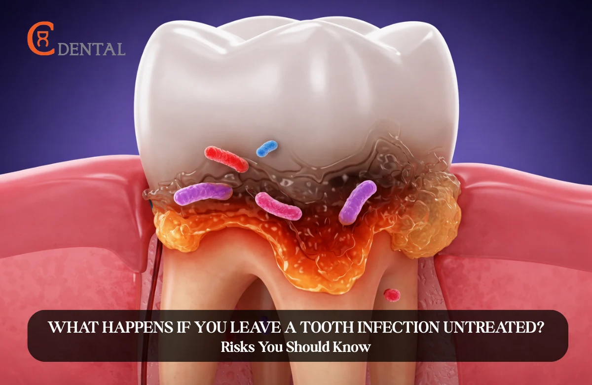 What Happens If You Leave a Tooth Infection Untreated? Risks You Should Know