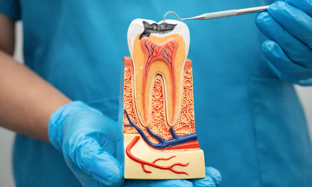 What Is Single Sitting Root Canal Treatment?