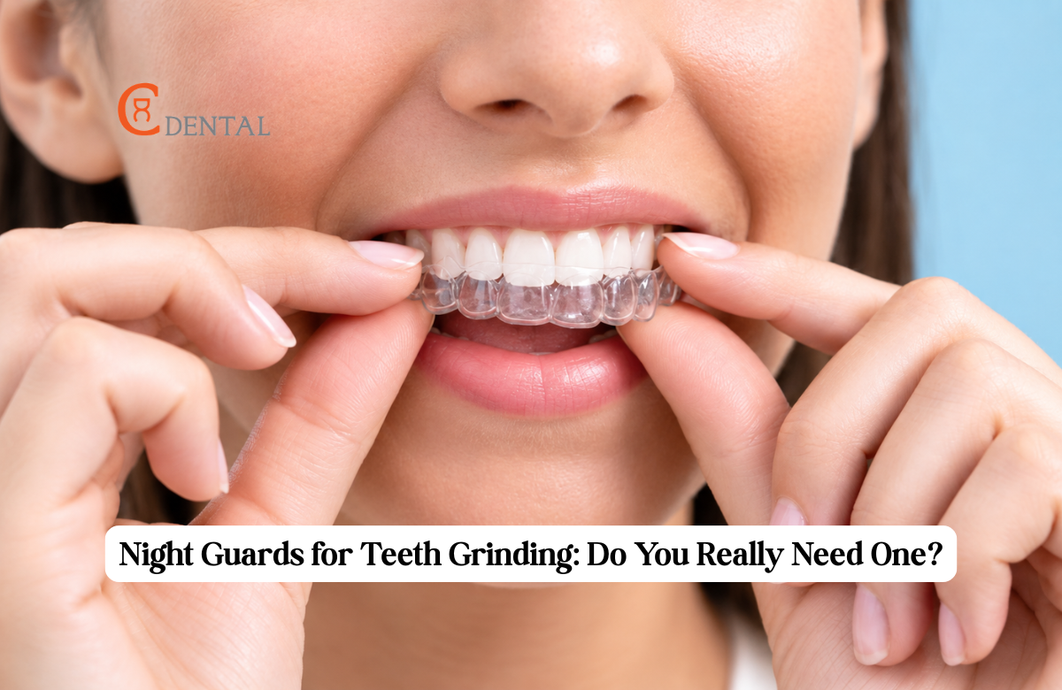 Woman inserting a clear custom night guard for teeth grinding